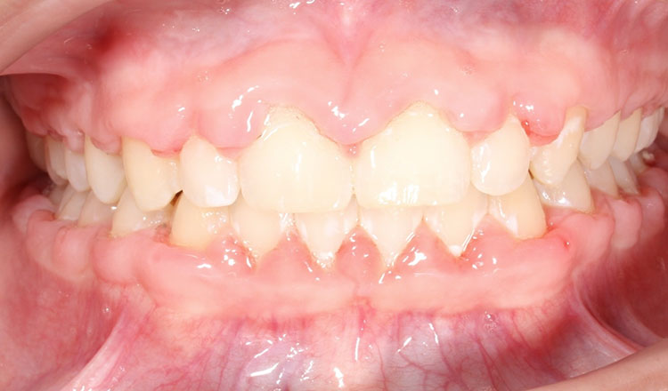 Class II orthodontic treatment after - patient 1