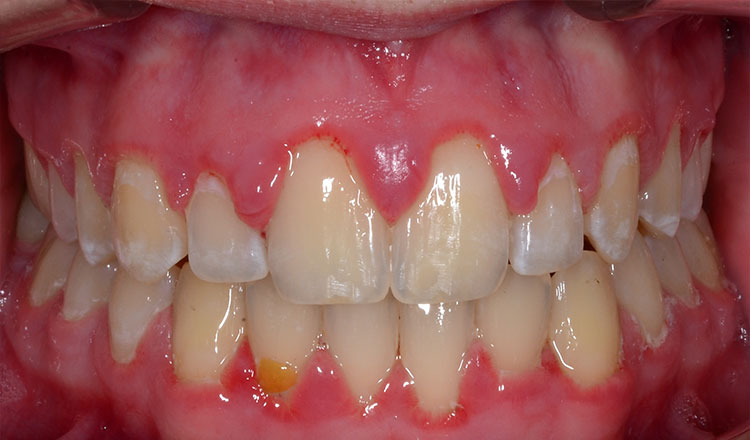 Open Bite orthodontic treatment after - patient 1