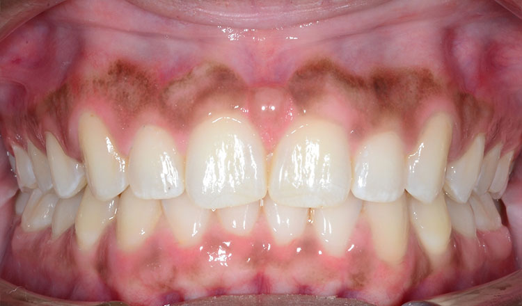 Spacing orthodontic treatment after - patient 1
