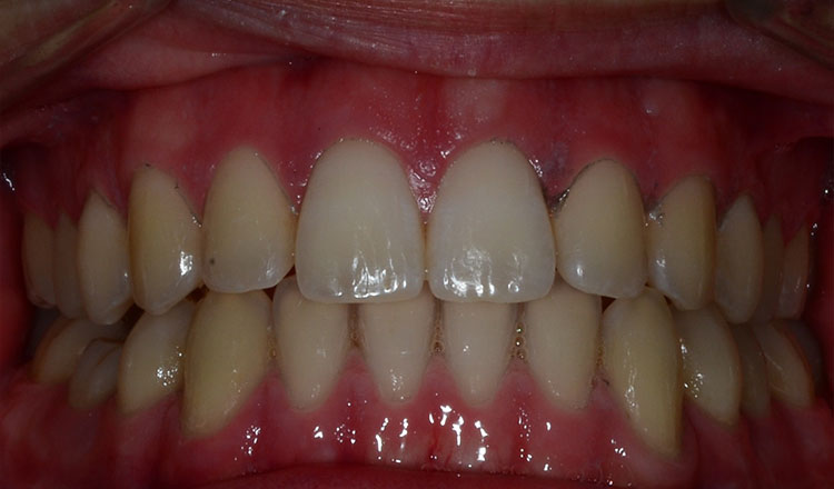 Surgery Cases orthodontic treatment after - patient 1