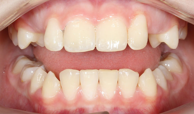 Phase I orthodontic treatment after - patient 1