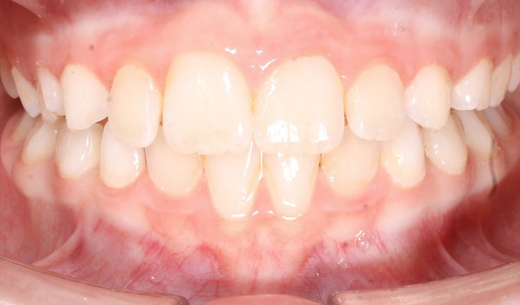 Invisalign First orthodontic treatment after - patient 1
