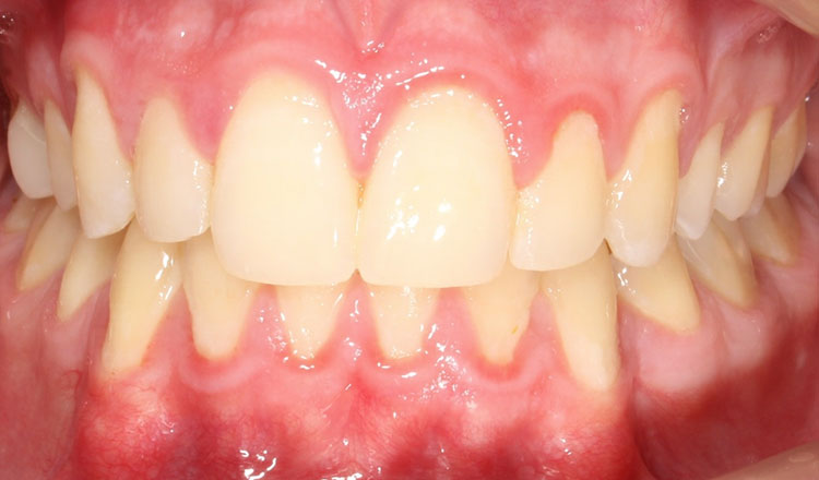 Combo TX orthodontic treatment after - patient 1