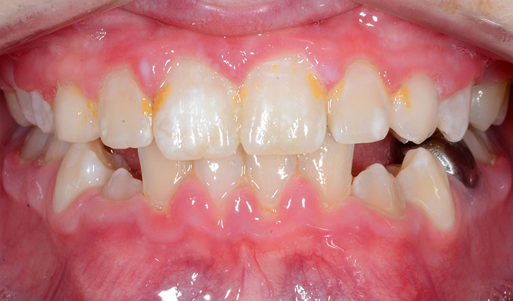 Crossbite orthodontic treatment after - patient 1