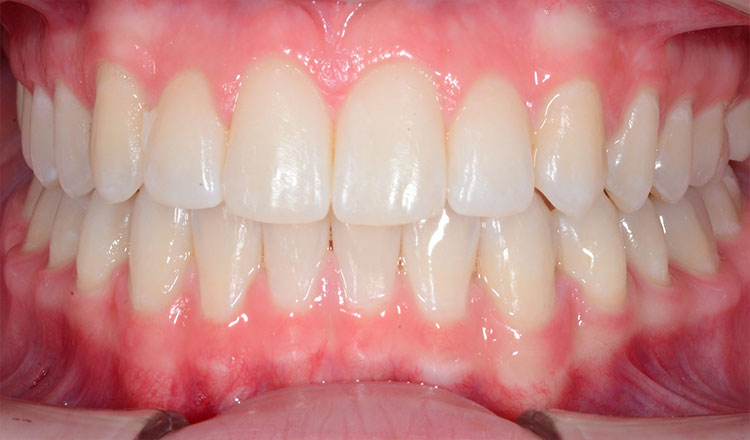 Crowding orthodontic treatment after - patient 1