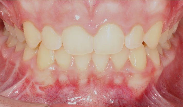Deepbite orthodontic treatment after - patient 1
