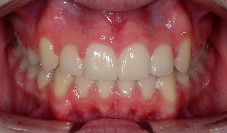 High Canines orthodontic treatment after - patient 1