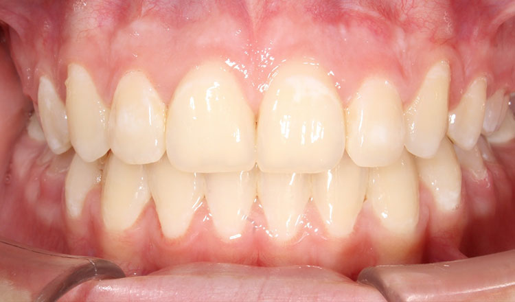 Impacted Canines orthodontic treatment after - patient 1