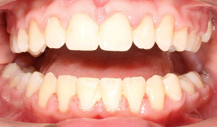 Missing Teeth orthodontic treatment after - patient 1