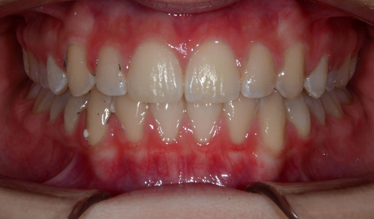 Narrow Arches orthodontic treatment after - patient 1