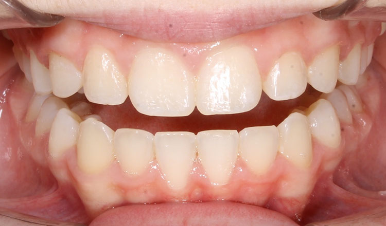 Both Phases orthodontic treatment after - patient 1