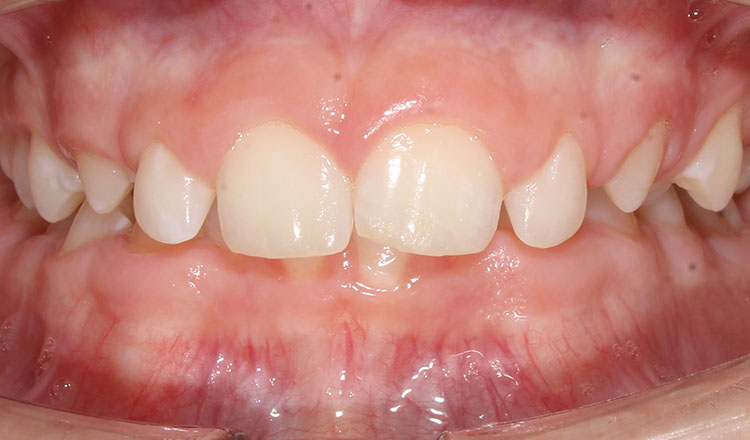 Class II orthodontic treatment before - patient 1