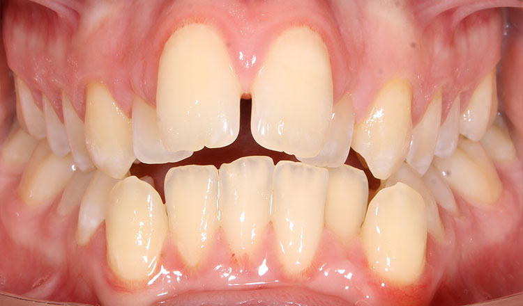 Open Bite orthodontic treatment before - patient 1