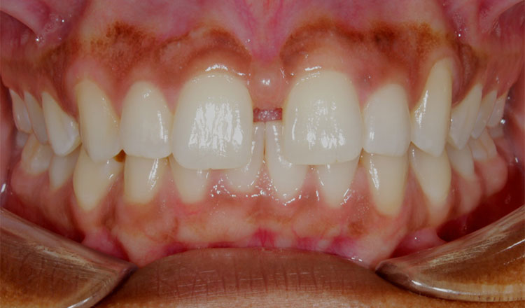 Spacing orthodontic treatment before - patient 1