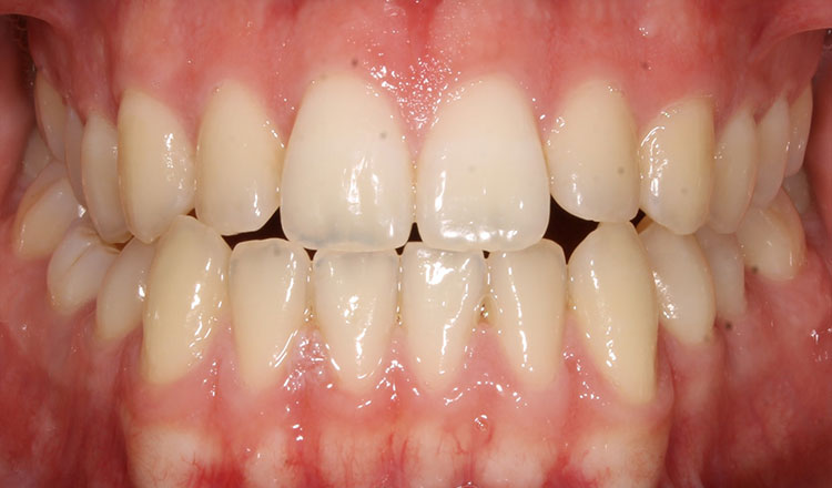 Surgery Cases orthodontic treatment before - patient 1