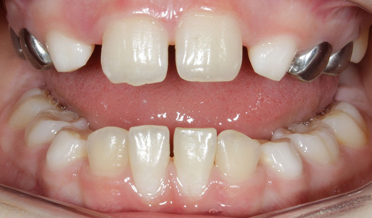 Phase I orthodontic treatment before - patient 1