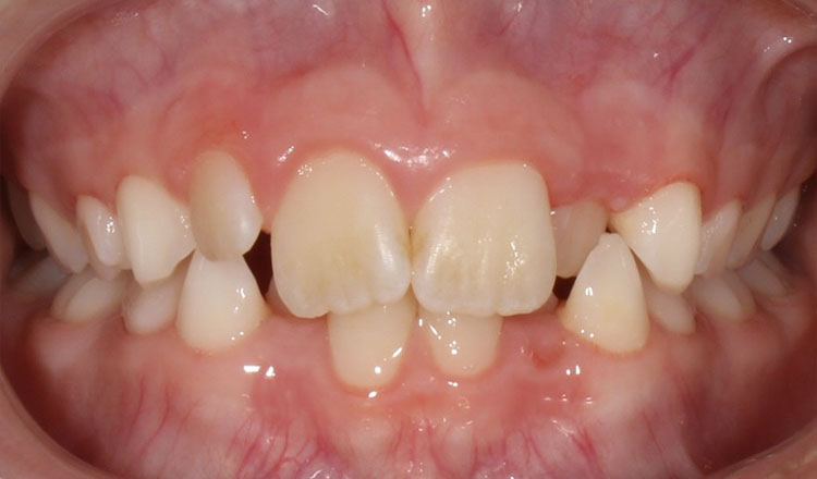 Invisalign First orthodontic treatment before - patient 1