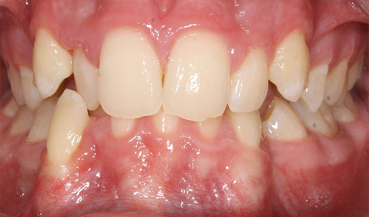 Combo TX orthodontic treatment before - patient 1