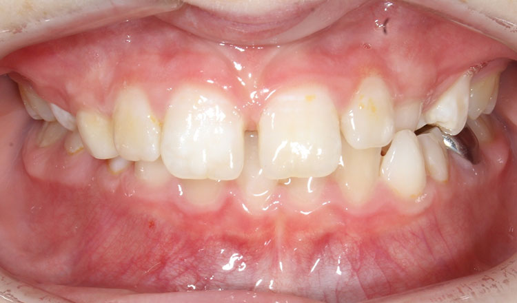 Crossbite orthodontic treatment before - patient 1