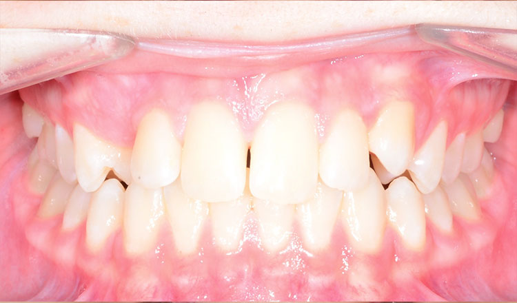 Crowding orthodontic treatment before - patient 1