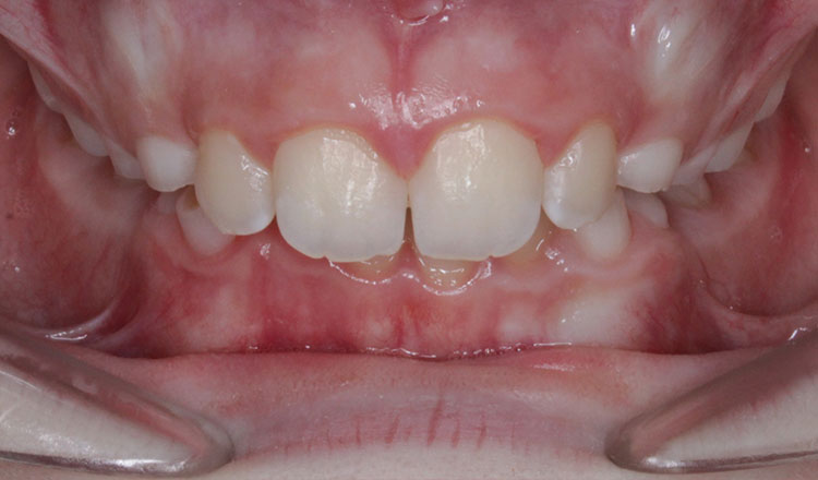 Deepbite orthodontic treatment before - patient 1