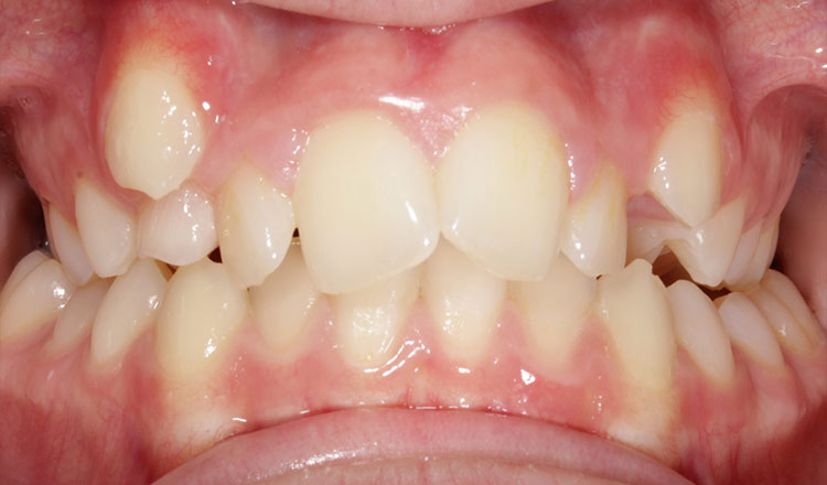 High Canines orthodontic treatment before - patient 1