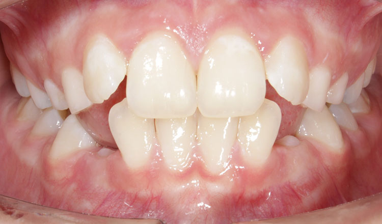 Impacted Canines orthodontic treatment before - patient 1