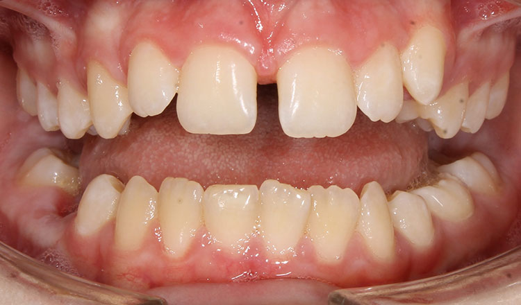 Missing Teeth orthodontic treatment before - patient 1