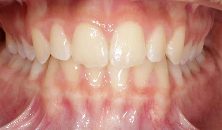 Narrow Arches orthodontic treatment before - patient 1