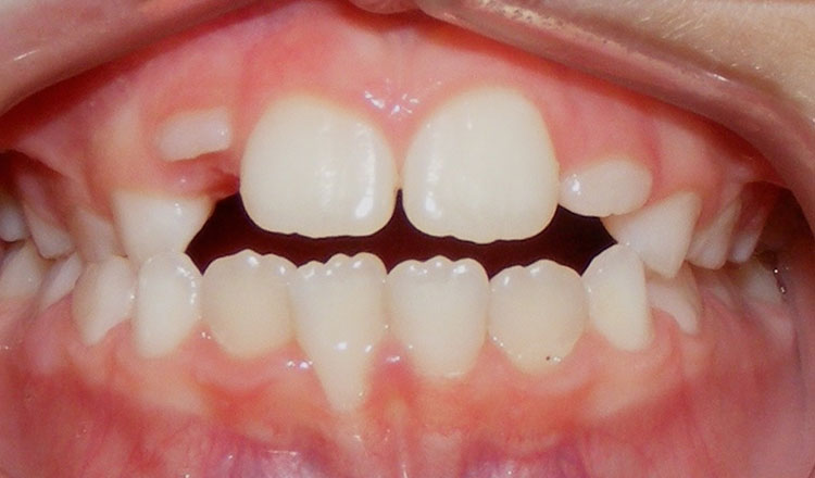 Both Phases orthodontic treatment before - patient 1