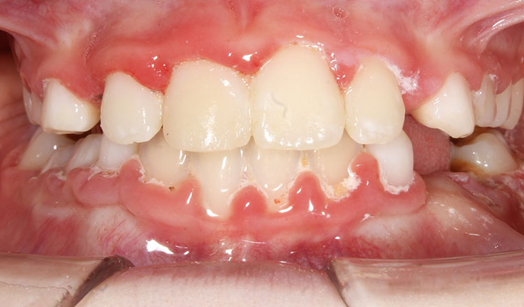 Phase I orthodontic treatment after - patient 10