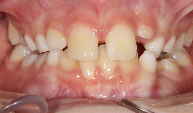 Phase I orthodontic treatment before - patient 10