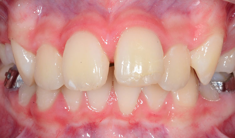 Phase I orthodontic treatment after - patient 11