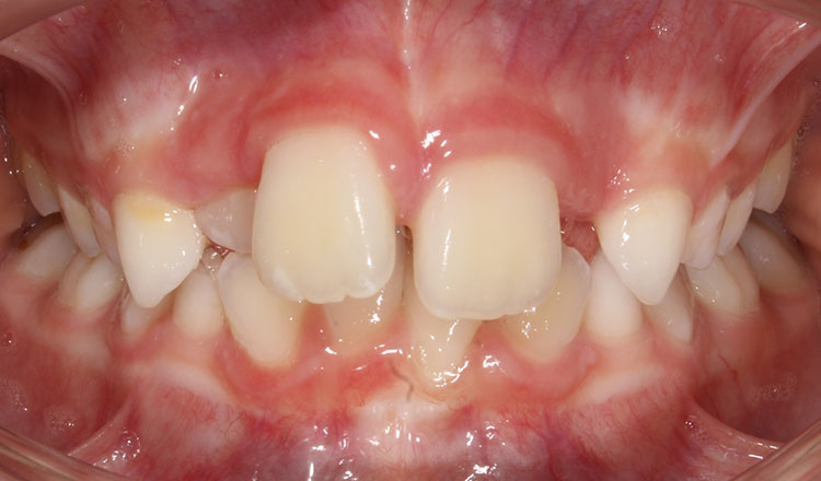 Phase I orthodontic treatment before - patient 11