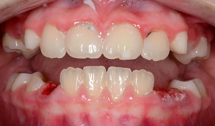 Phase I orthodontic treatment after - patient 12