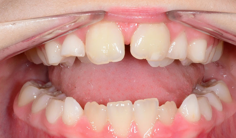 Phase I orthodontic treatment before - patient 12