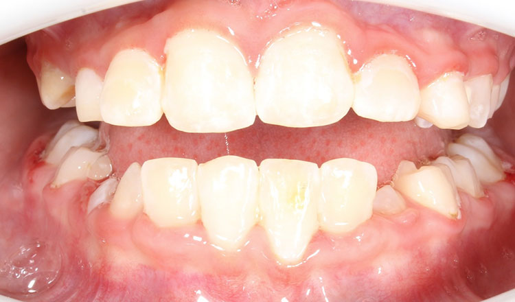 Phase I orthodontic treatment after - patient 13