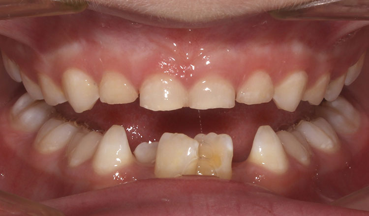 Phase I orthodontic treatment before - patient 13