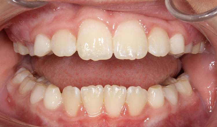 Phase I orthodontic treatment after - patient 14