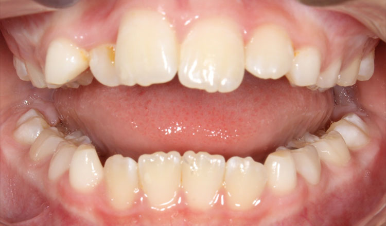 Phase I orthodontic treatment before - patient 14