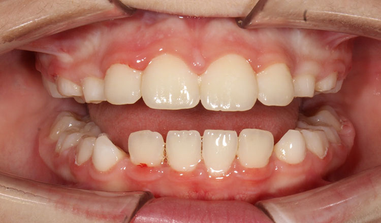 Phase I orthodontic treatment after - patient 15
