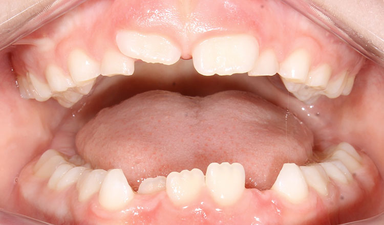 Phase I orthodontic treatment before - patient 15