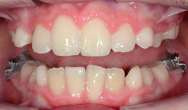 Phase I orthodontic treatment after - patient 16