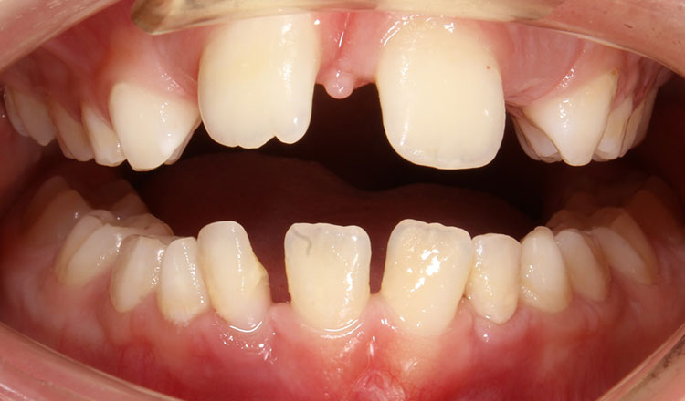 Phase I orthodontic treatment before - patient 16