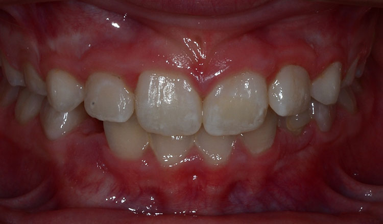 Phase I orthodontic treatment after - patient 17