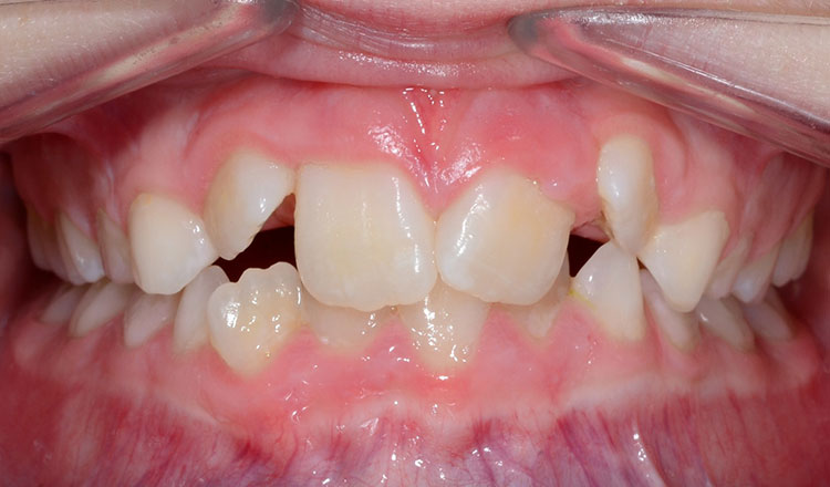 Phase I orthodontic treatment before - patient 17