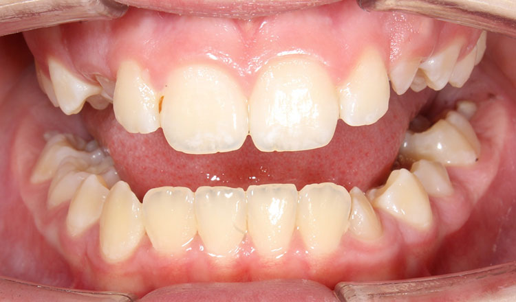Phase I orthodontic treatment after - patient 18