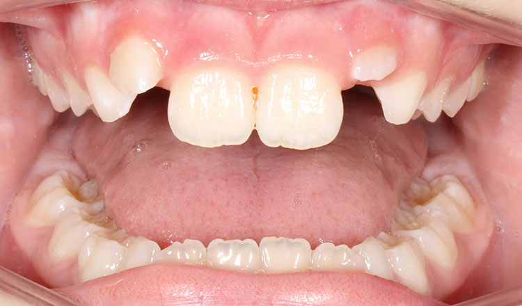 Phase I orthodontic treatment before - patient 18