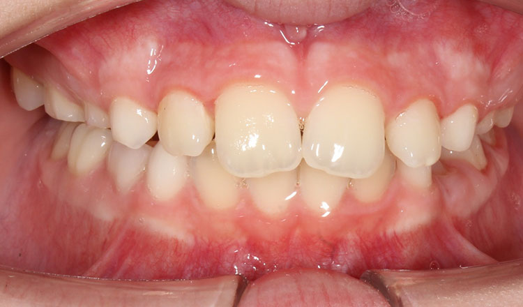 Phase I orthodontic treatment after - patient 19