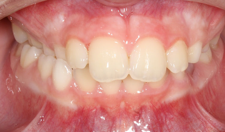 Phase I orthodontic treatment before - patient 19